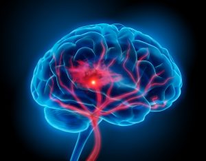 Esclerose múltipla leva as células de defesa do organismo humano a infligir danos no próprio sistema nervoso central, causando lesões no cérebro e na medula espinhal (Foto:  Fotolia)