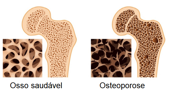 Morfologia de um osso saudável e de um com osteoporose